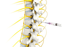Epidural Spinal Injections