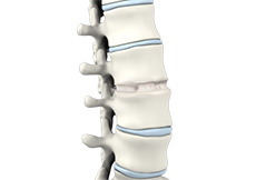 Anterior Lumbar Interbody Fusion