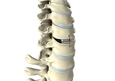 Artificial Cervical Disc Replacement