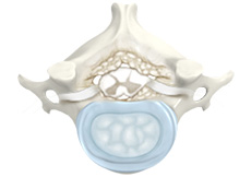 Cervical Degenerative Disc Disease