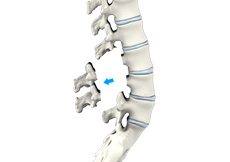 Lumbar Laminectomy