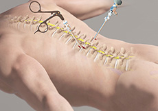 Minimally Invasive Spine Surgery