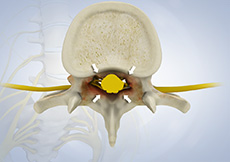 Cervical Stenosis