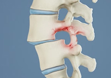 Spondylolisthesis