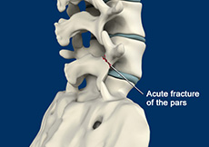 Spondylolysis 