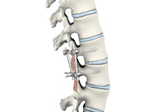 Lumbar Interbody Fusion